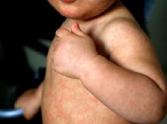 BVI gears up for potential measles outbreak