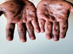 CARICOM Chair Urges Increased Mpox Vigilance in Caribbean